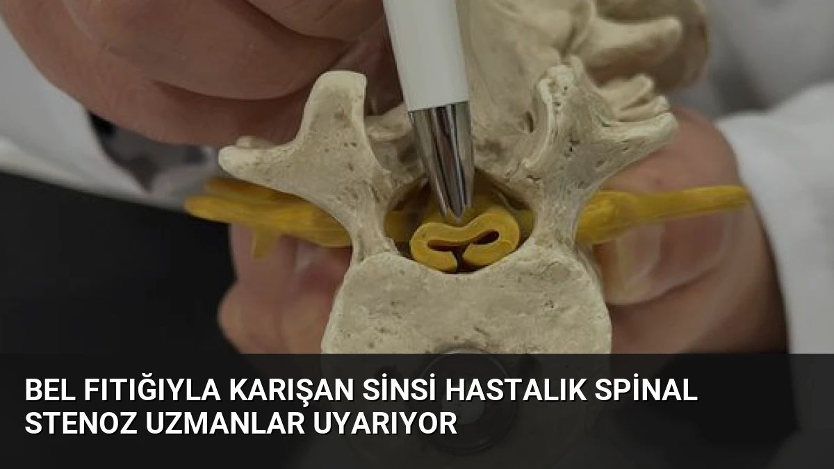 Bel Fıtığıyla Karışan Sinsi Hastalık Spinal Stenoz Uzmanlar Uyarıyor