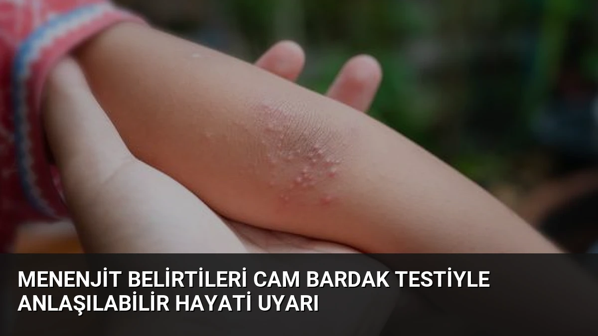 Menenjit Belirtileri Cam Bardak Testiyle Anlaşılabilir Hayati Uyarı