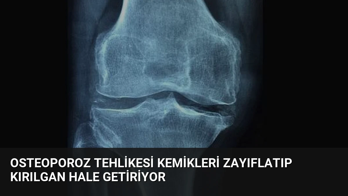 Osteoporoz Tehlikesi Kemikleri Zayıflatıp Kırılgan Hale Getiriyor
