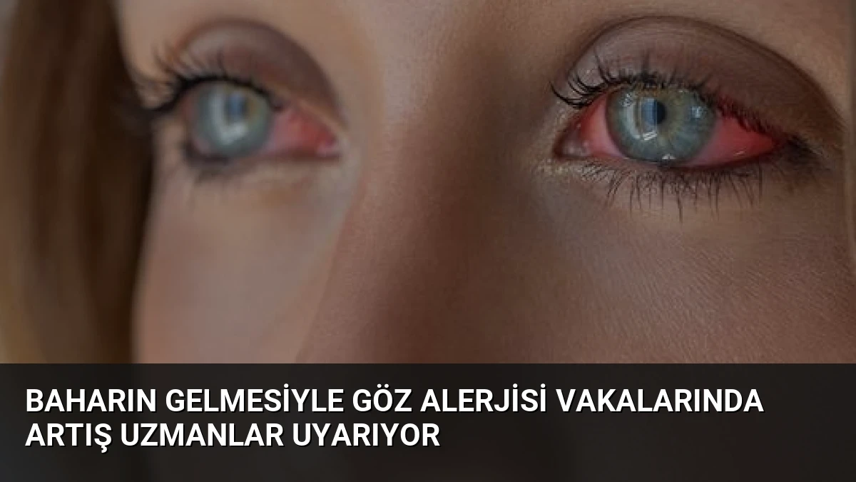 Baharın Gelmesiyle Göz Alerjisi Vakalarında Artış Uzmanlar Uyarıyor