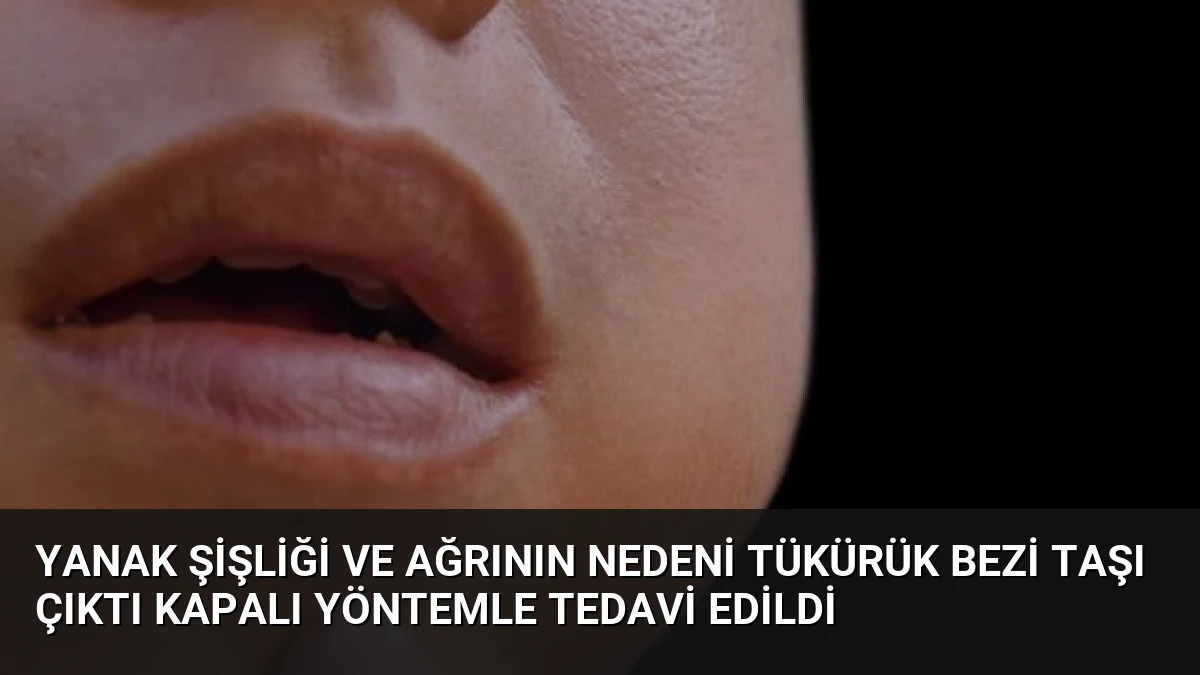 Yanak Şişliği ve Ağrının Nedeni Tükürük Bezi Taşı Çıktı Kapalı Yöntemle Tedavi Edildi